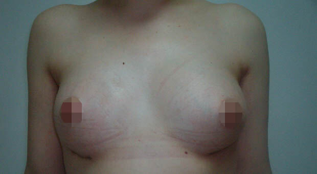 Mirabiliss Polyclinic - Gallery - After Breast Asymmetry Correction Surgery 01