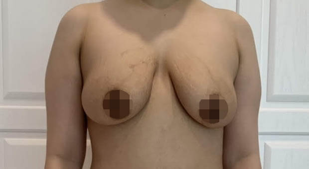 Mirabiliss Polyclinic - Gallery - Before Breast Lifting Surgery 01