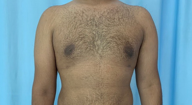 Mirabiliss Polyclinic – Gallery – After Men Breast Reduction Surgery 01
