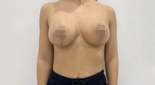 Mirabiliss Polyclinic – Gallery – After Breast Reduction Surgery 02