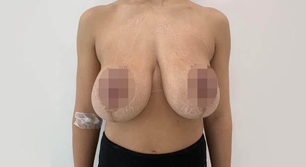 Poliklinika Mirabiliss, Niš - Plastična hirurgija - Smanjenje grudi - Pre 02
