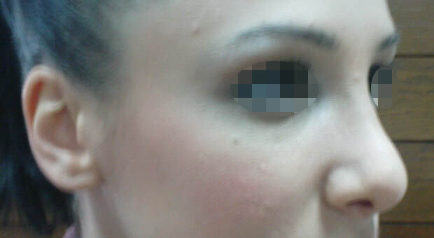 Mirabiliss Polyclinic – Gallery – After Nose Surgery 01